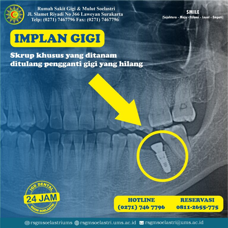 Read more about the article Implan Gigi