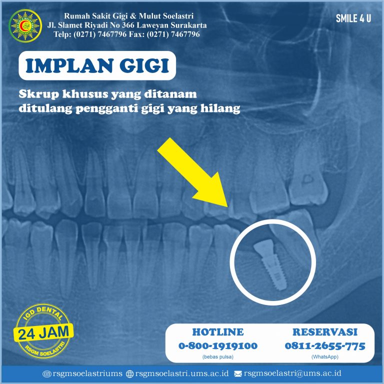 Read more about the article IMPLAN GIGI