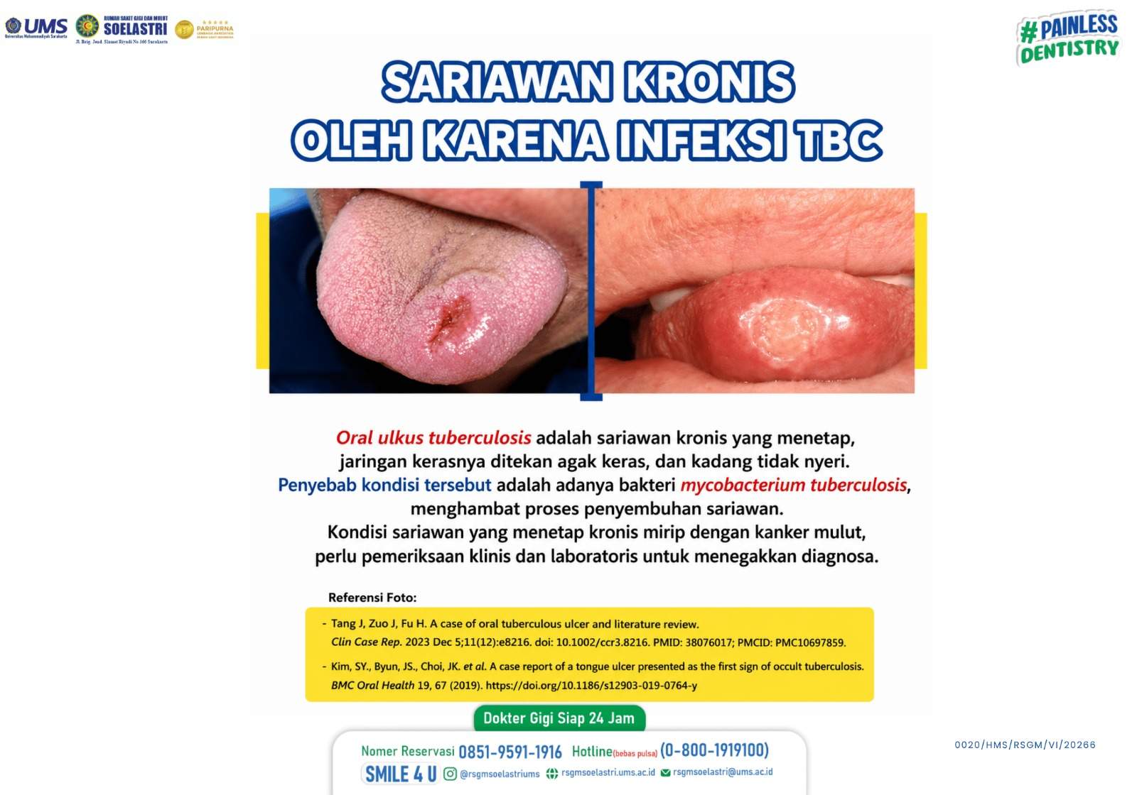 You are currently viewing Sariawan Kronis Oleh Karena Infeksi TBC